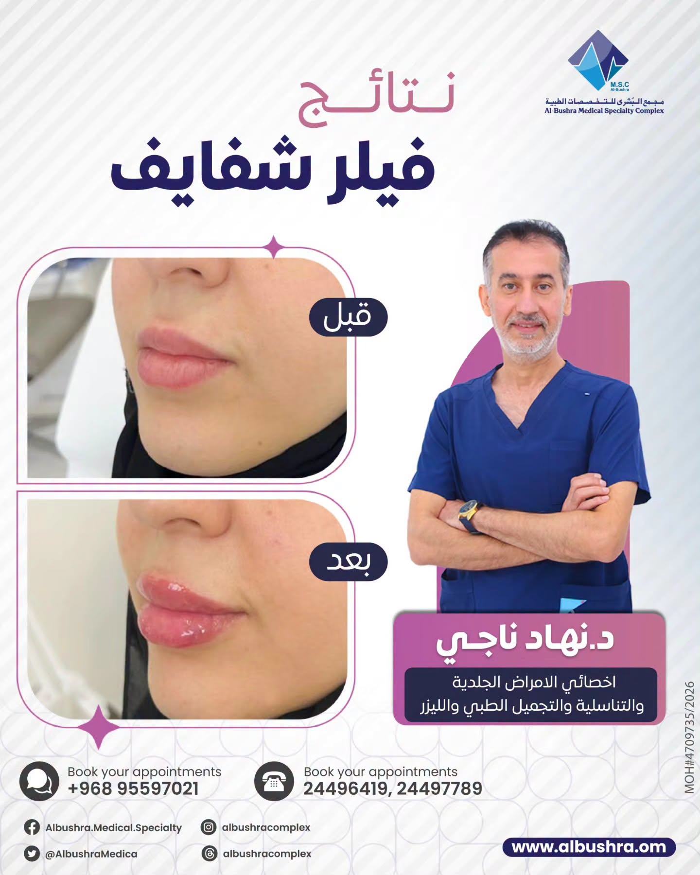 نتائج فيلر الشفاه