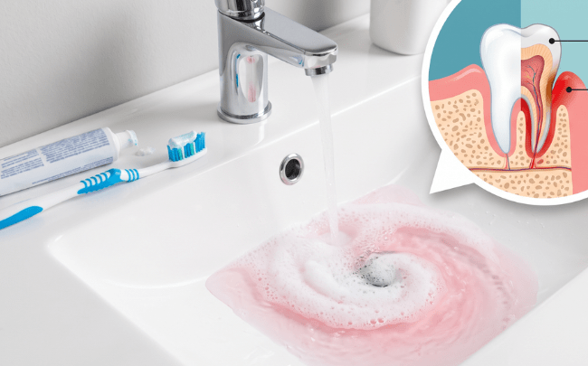 Pink toothpaste foam draining into a sink next to a toothbrush, illustrating the early signs of bleeding gums.